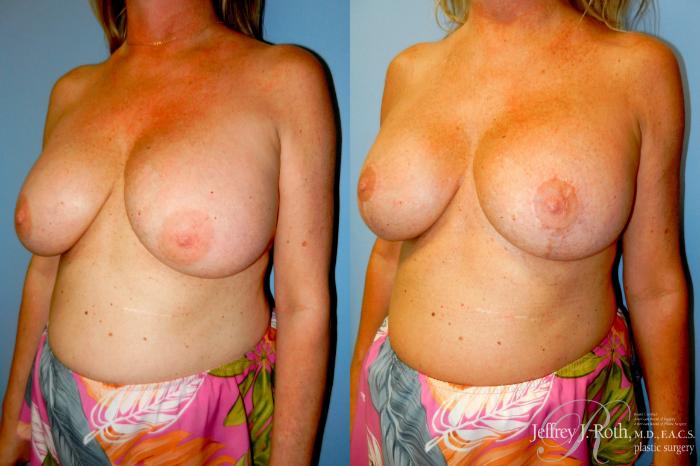 Before & After Breast Augmentation Revision Case 322 Left Oblique View in Las Vegas and Henderson, NV
