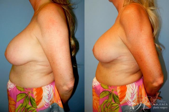 Before & After Breast Augmentation Revision Case 322 Left Side View in Las Vegas and Henderson, NV