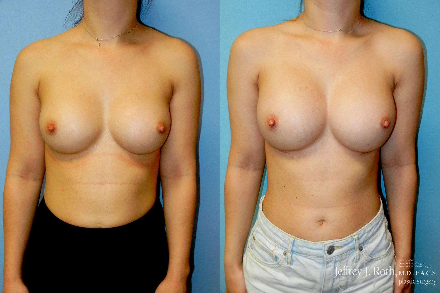 Before & After Breast Augmentation Revision Case 330 Front View in Las Vegas and Henderson, NV