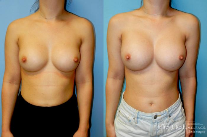 Before & After Breast Augmentation Revision Case 330 Front View in Las Vegas and Henderson, NV