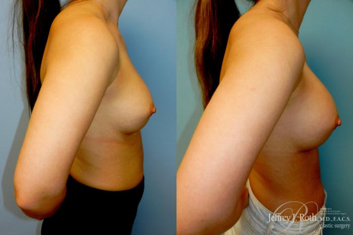 Before & After Breast Augmentation Revision Case 330 Left Side View in Las Vegas and Henderson, NV