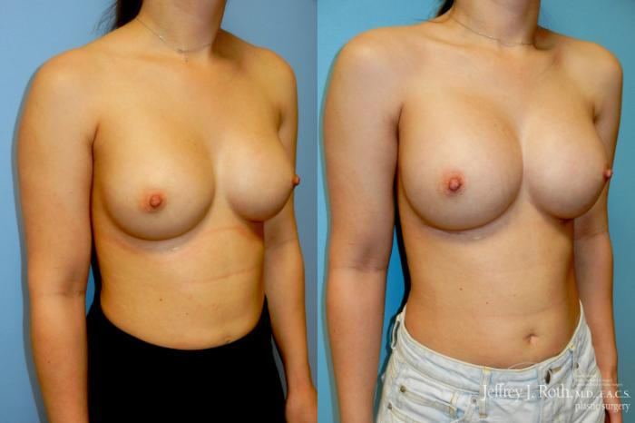 Before & After Breast Augmentation Revision Case 330 Right Oblique View in Las Vegas and Henderson, NV