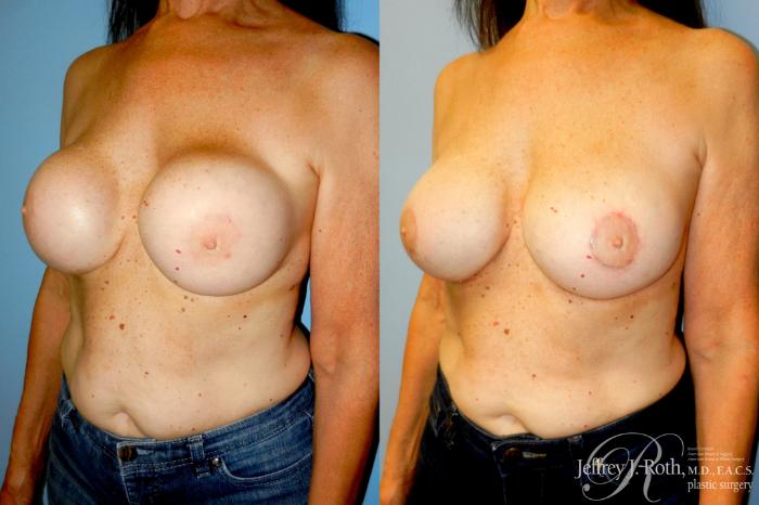 Before & After Breast Augmentation Revision Case 344 Left Oblique View in Las Vegas and Henderson, NV