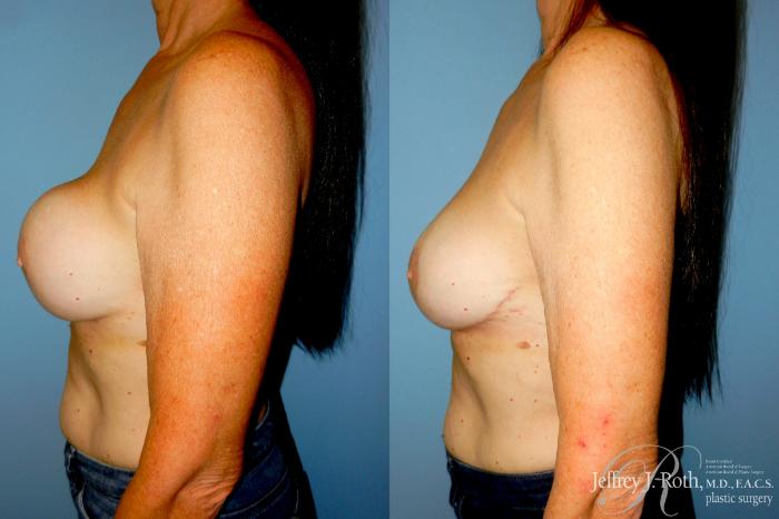 Before & After Breast Augmentation Revision Case 344 Left Side View in Las Vegas and Henderson, NV