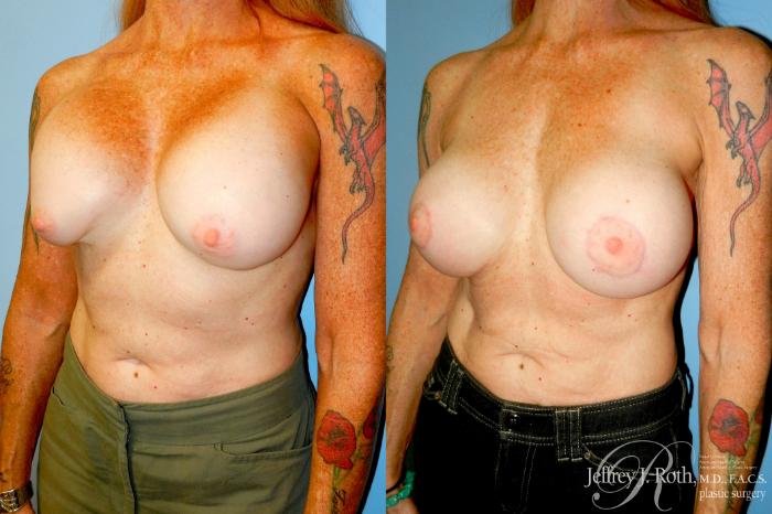Before & After Breast Augmentation Revision Case 349 Left Oblique View in Las Vegas and Henderson, NV