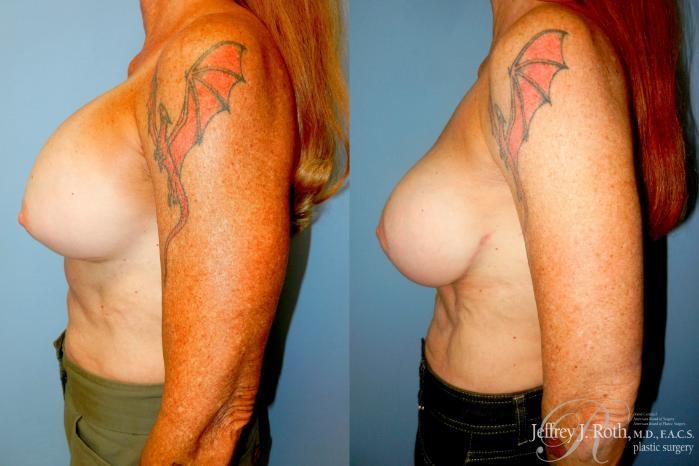 Before & After Breast Augmentation Revision Case 349 Left Side View in Las Vegas and Henderson, NV