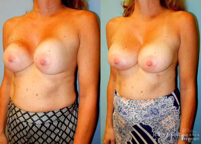 Before & After Breast Augmentation Revision Case 98 View #2 View in Las Vegas and Henderson, NV