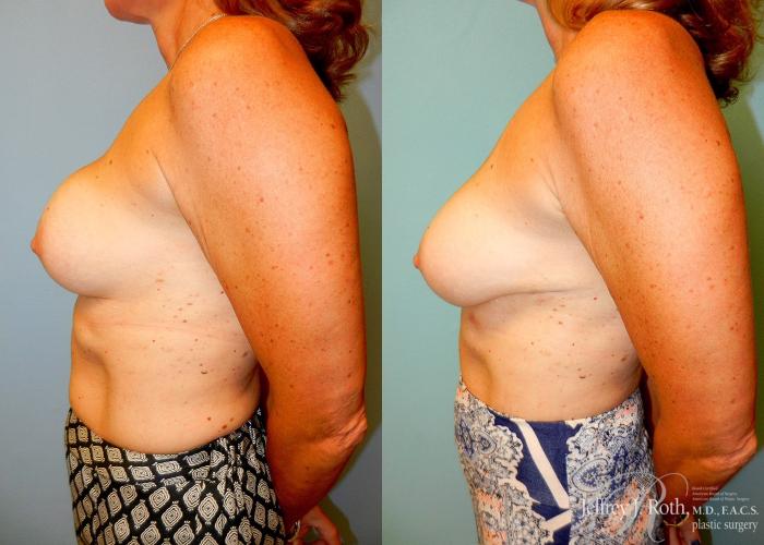 Before & After Breast Augmentation Revision Case 98 View #3 View in Las Vegas and Henderson, NV