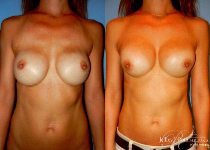 Before & After Breast Augmentation Revision Case 99 View #1 View in Las Vegas, NV