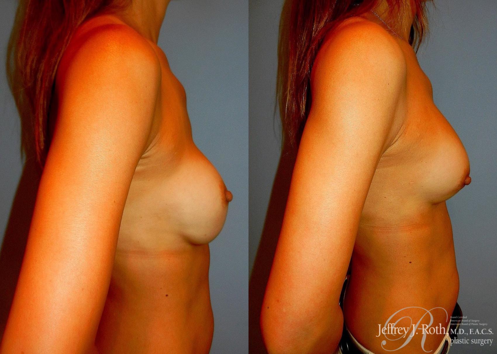 Before & After Breast Augmentation Revision Case 99 View #3 View in Las Vegas, NV
