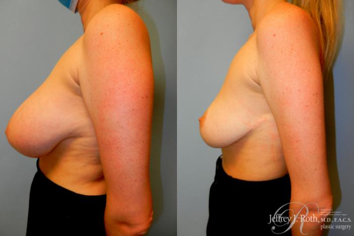 Before & After Breast Lift Case 231 Left Side View in Las Vegas, NV
