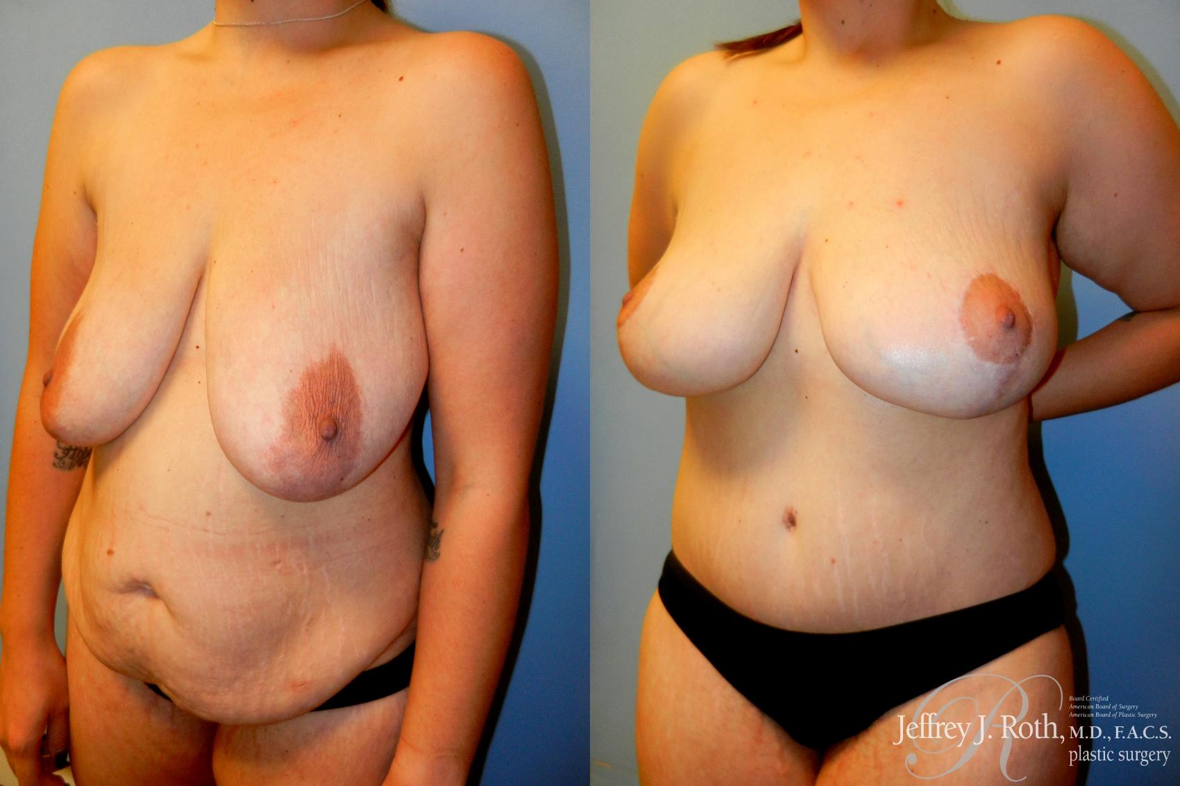 Before & After Breast Lift Case 234 Left Oblique View in Las Vegas, NV