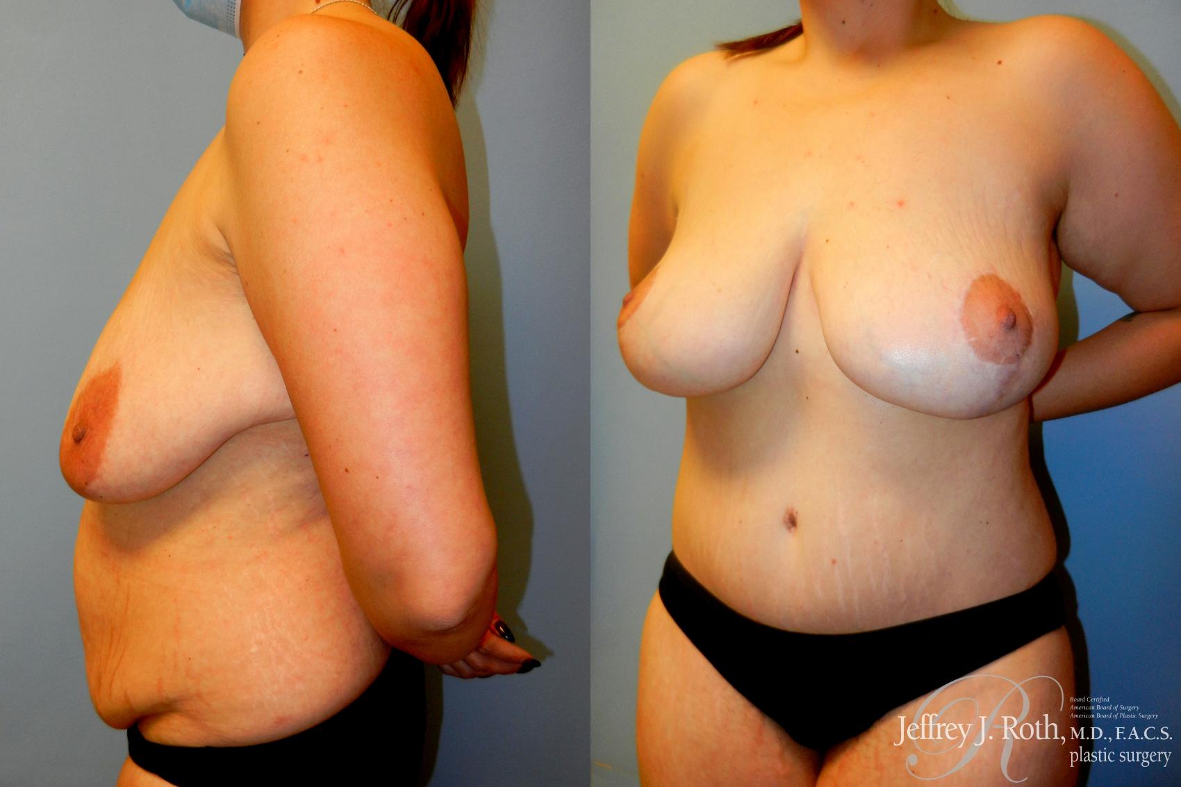 Before & After Breast Lift Case 234 Left Side View in Las Vegas, NV