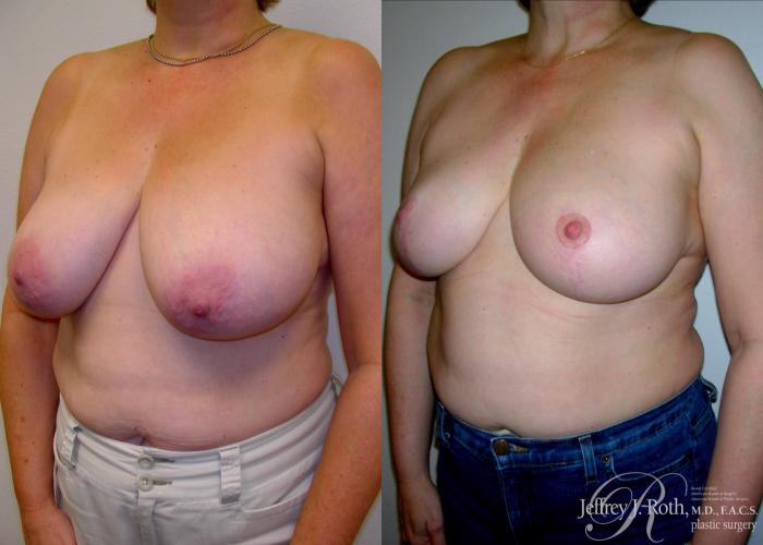 Before & After Breast Lift Case 59 View #2 View in Las Vegas, NV