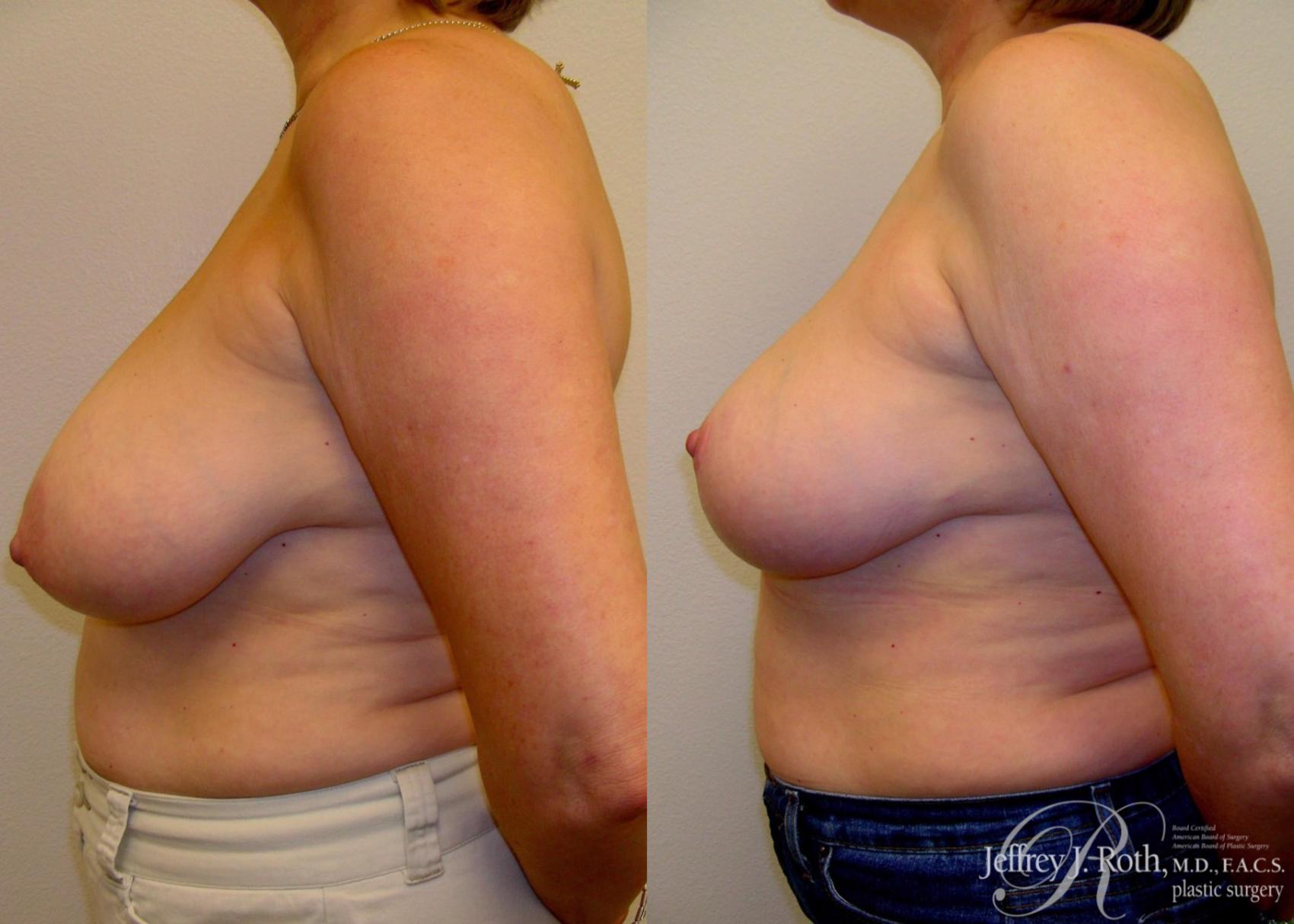 Before & After Breast Lift Case 59 View #3 View in Las Vegas, NV