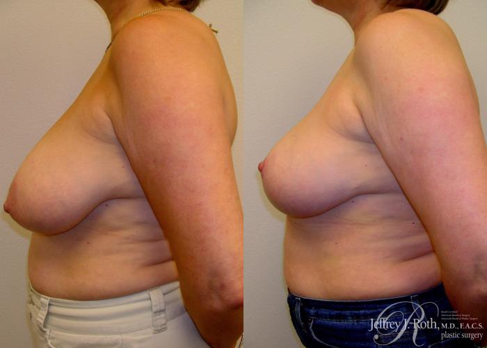 Before & After Breast Lift Case 59 View #3 View in Las Vegas, NV