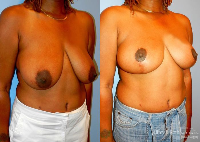 Before & After Breast Lift Case 60 View #2 View in Las Vegas and Henderson, NV