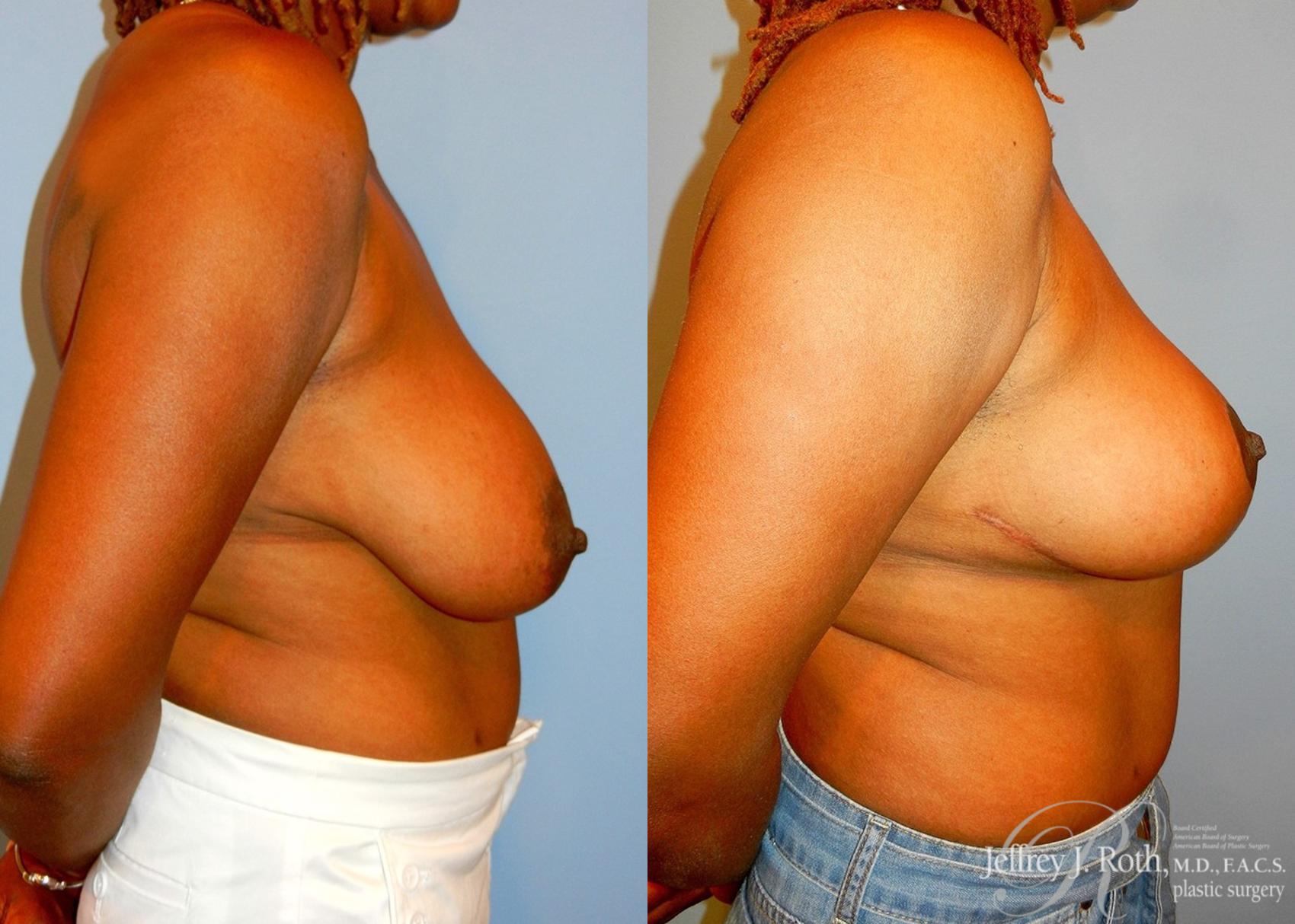 Before & After Breast Lift Case 60 View #3 View in Las Vegas, NV