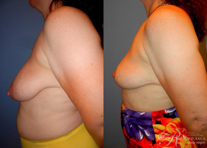Before & After Breast Lift Case 61 View #3 View in Las Vegas and Henderson, NV