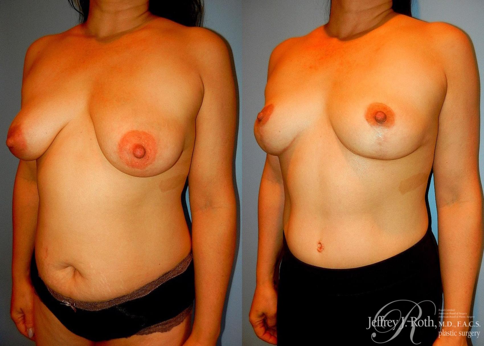 Before & After Breast Lift Case 62 View #2 View in Las Vegas, NV
