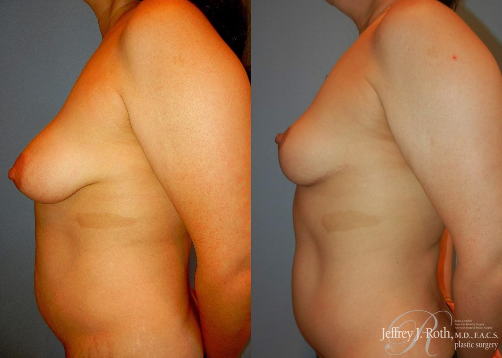 Before & After Breast Lift Case 62 View #3 View in Las Vegas, NV