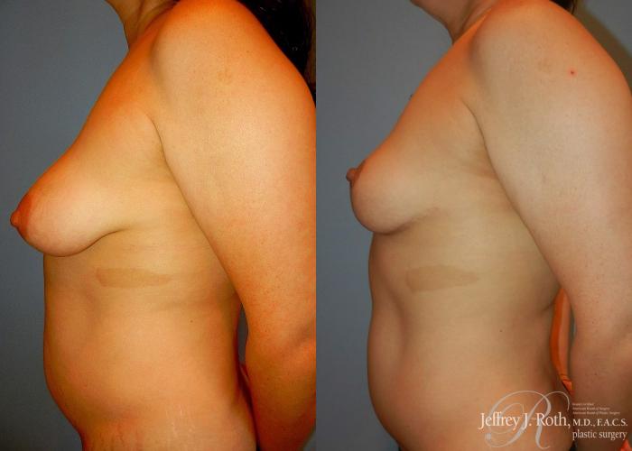 Before & After Breast Lift Case 62 View #3 View in Las Vegas and Henderson, NV
