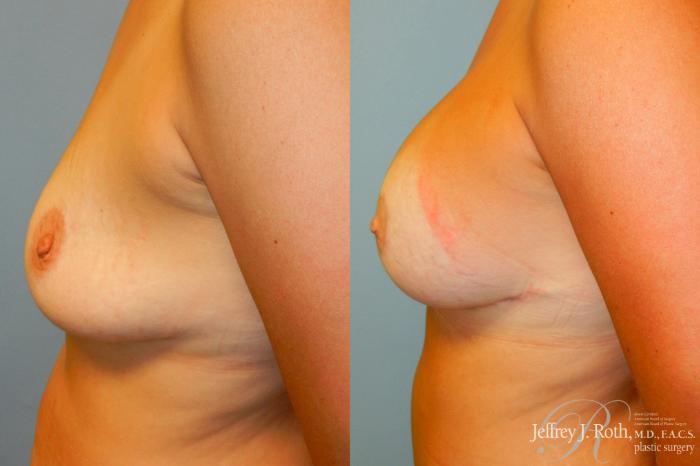Before & After Breast Lift With Implants Case 246 Left Side View in Las Vegas and Henderson, NV