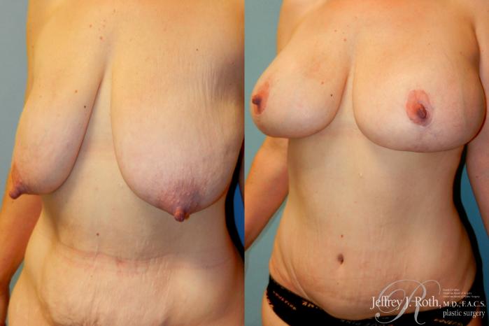 Before & After Breast Lift With Implants Case 269 Left Oblique View in Las Vegas and Henderson, NV