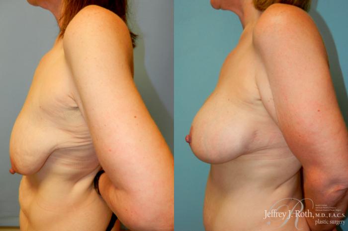 Before & After Breast Lift With Implants Case 269 Left Side View in Las Vegas and Henderson, NV