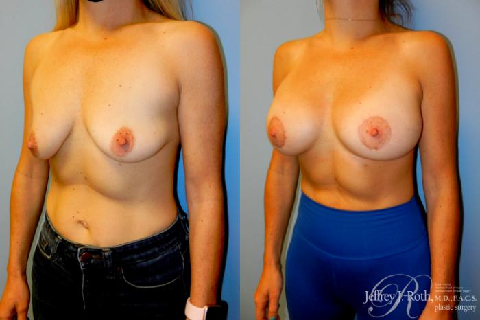 Before & After Breast Lift With Implants Case 293 Left Oblique View in Las Vegas and Henderson, NV