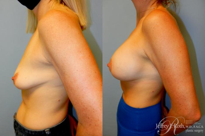 Before & After Breast Lift With Implants Case 293 Left Side View in Las Vegas and Henderson, NV