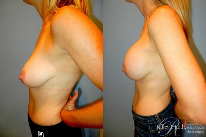 Before & After Breast Lift With Implants Case 295 Left Side View in Las Vegas and Henderson, NV