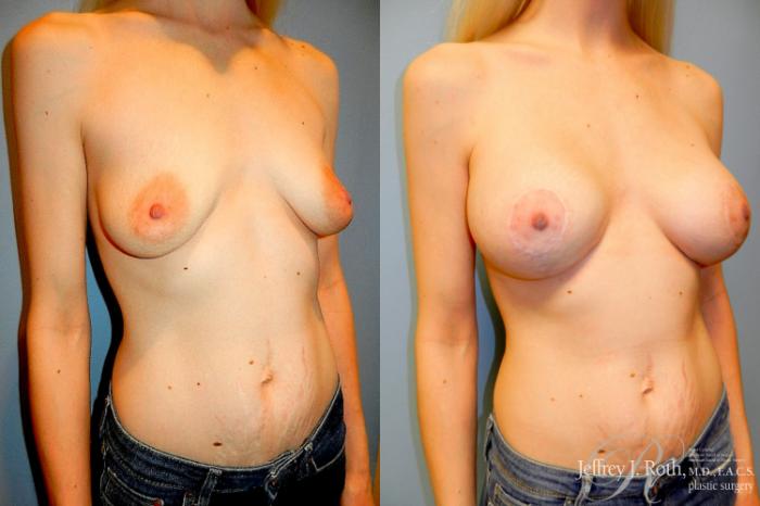 Before & After Breast Lift With Implants Case 296 Right Oblique View in Las Vegas and Henderson, NV