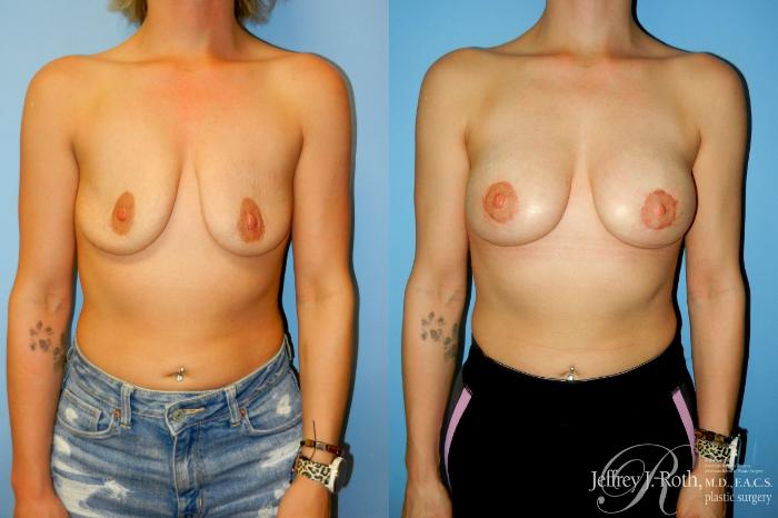 Before & After Breast Lift With Implants Case 302 Front View in Las Vegas and Henderson, NV