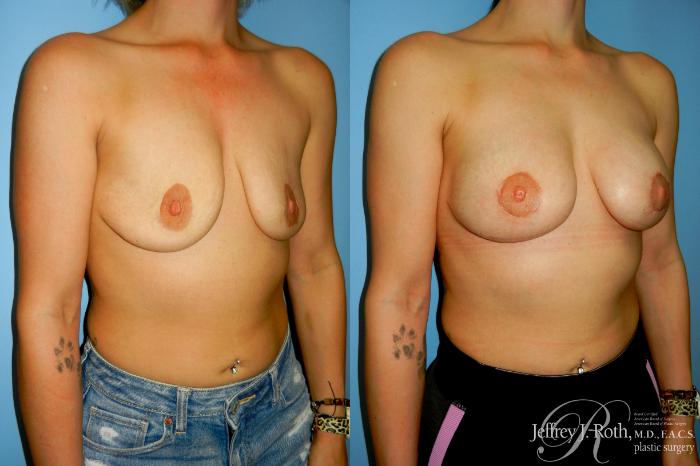 Before & After Breast Lift With Implants Case 302 Right Oblique View in Las Vegas and Henderson, NV