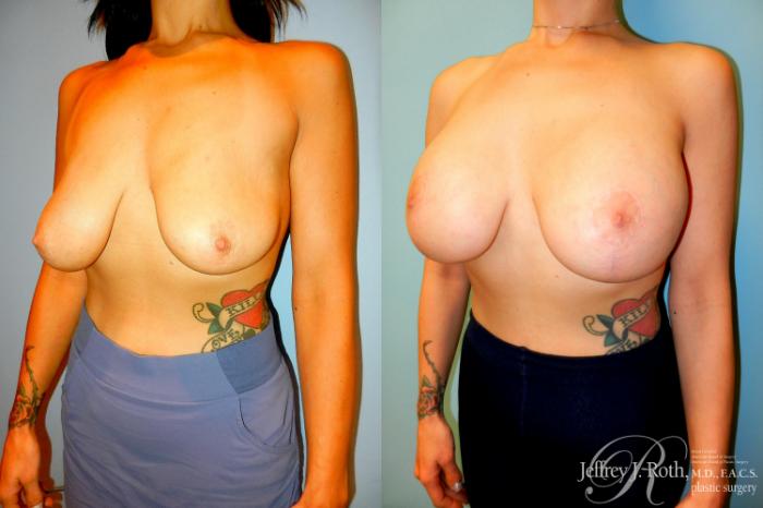 Before & After Breast Lift With Implants Case 303 Left Oblique View in Las Vegas and Henderson, NV
