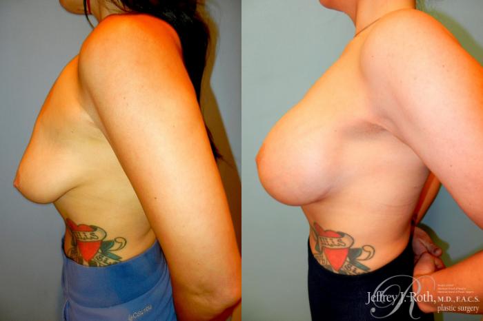 Before & After Breast Lift With Implants Case 303 Left Side View in Las Vegas and Henderson, NV