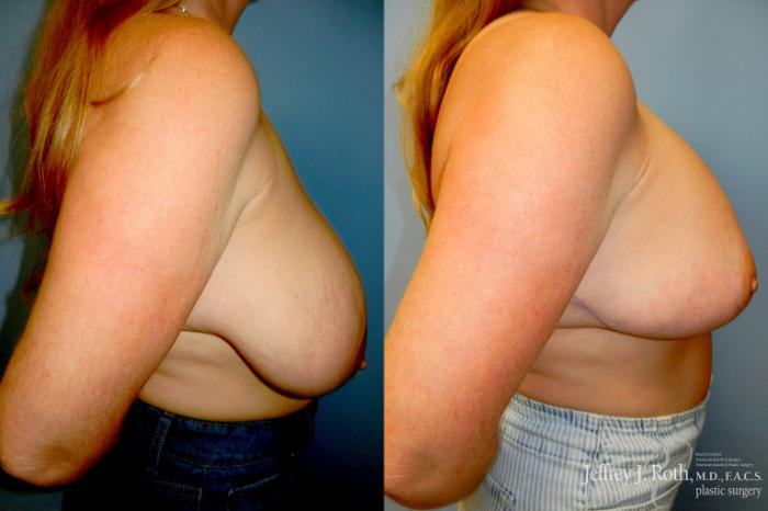 Before & After Breast Lift With Implants Case 314 Right Side View in Las Vegas and Henderson, NV