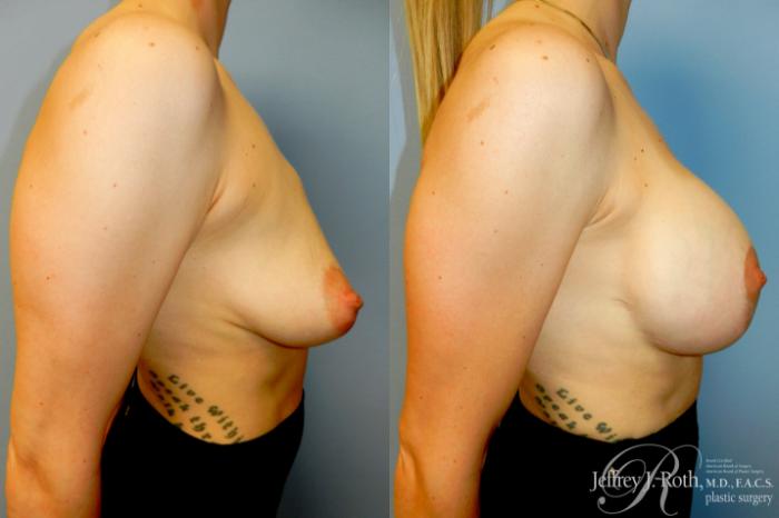 Before & After Breast Lift With Implants Case 331 Right Side View in Las Vegas and Henderson, NV