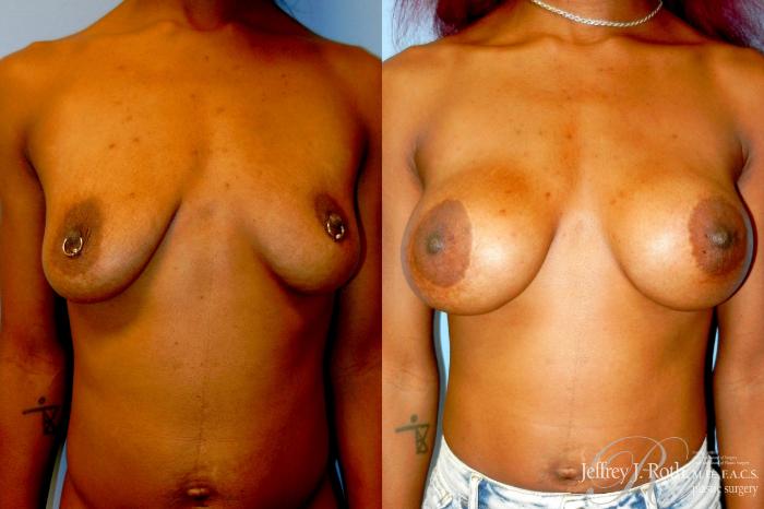 Before & After Breast Lift With Implants Case 333 Front View in Las Vegas and Henderson, NV