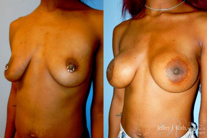 Before & After Breast Lift With Implants Case 333 Left Oblique View in Las Vegas and Henderson, NV
