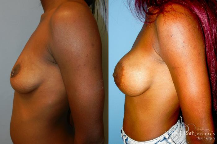 Before & After Breast Lift With Implants Case 333 Left Side View in Las Vegas and Henderson, NV
