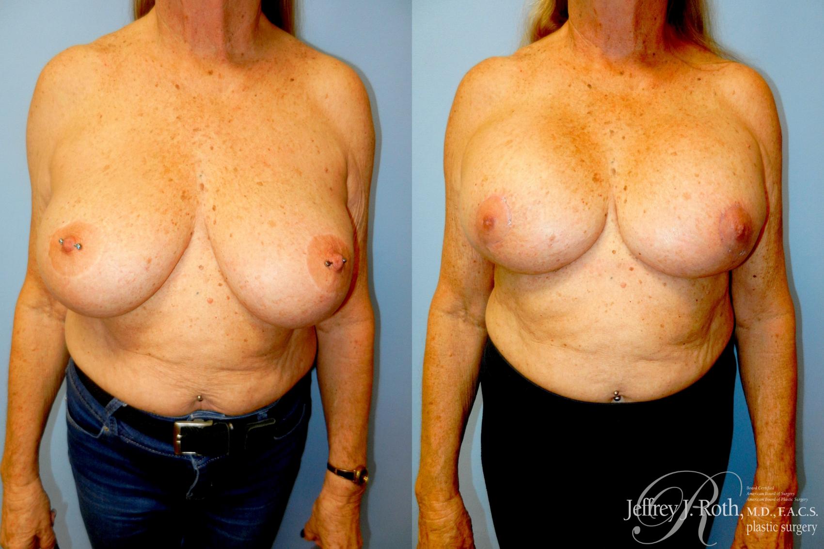 Before & After Breast Lift With Implants Case 336 Front View in Las Vegas and Henderson, NV