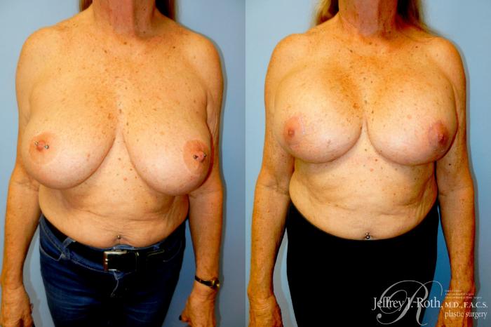Before & After Breast Lift With Implants Case 336 Front View in Las Vegas and Henderson, NV