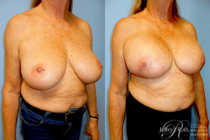 Before & After Breast Lift With Implants Case 336 Right Oblique View in Las Vegas and Henderson, NV