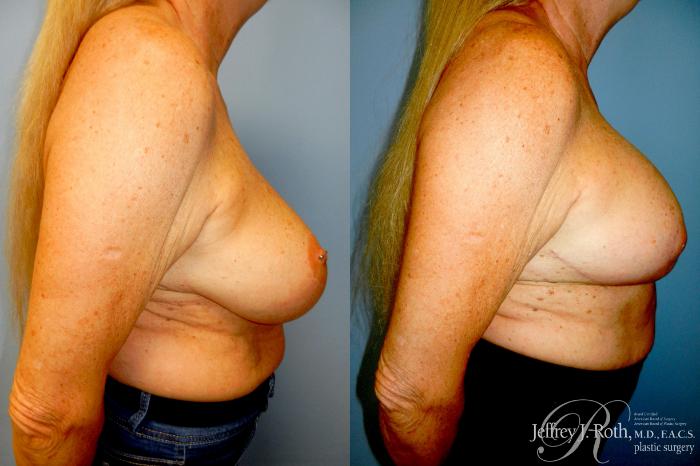 Before & After Breast Lift With Implants Case 336 Right Side View in Las Vegas and Henderson, NV