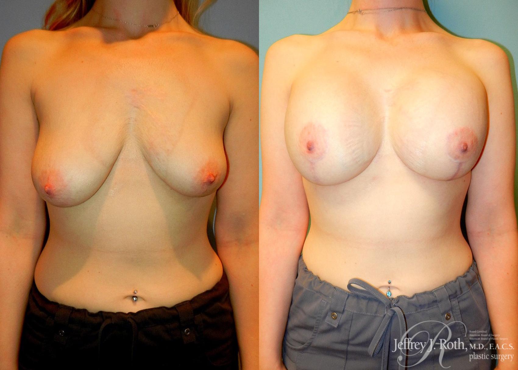 Before & After Breast Lift With Implants Case 63 View #1 View in Las Vegas and Henderson, NV