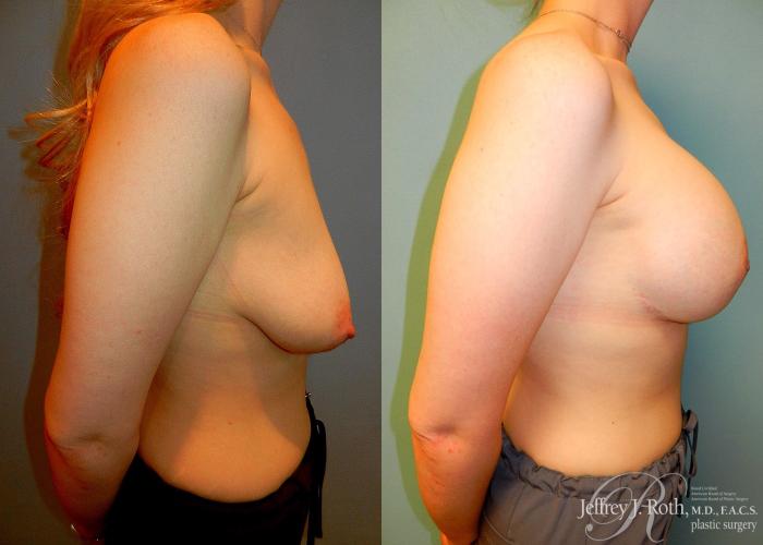 Before & After Breast Lift With Implants Case 63 View #3 View in Las Vegas, NV