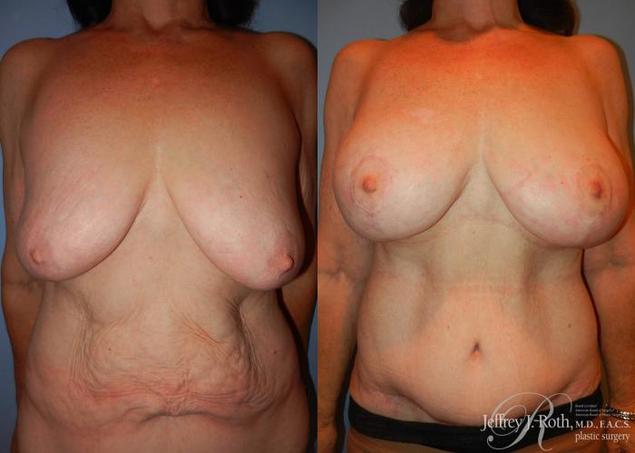 Before & After Breast Lift With Implants Case 64 View #1 View in Las Vegas, NV