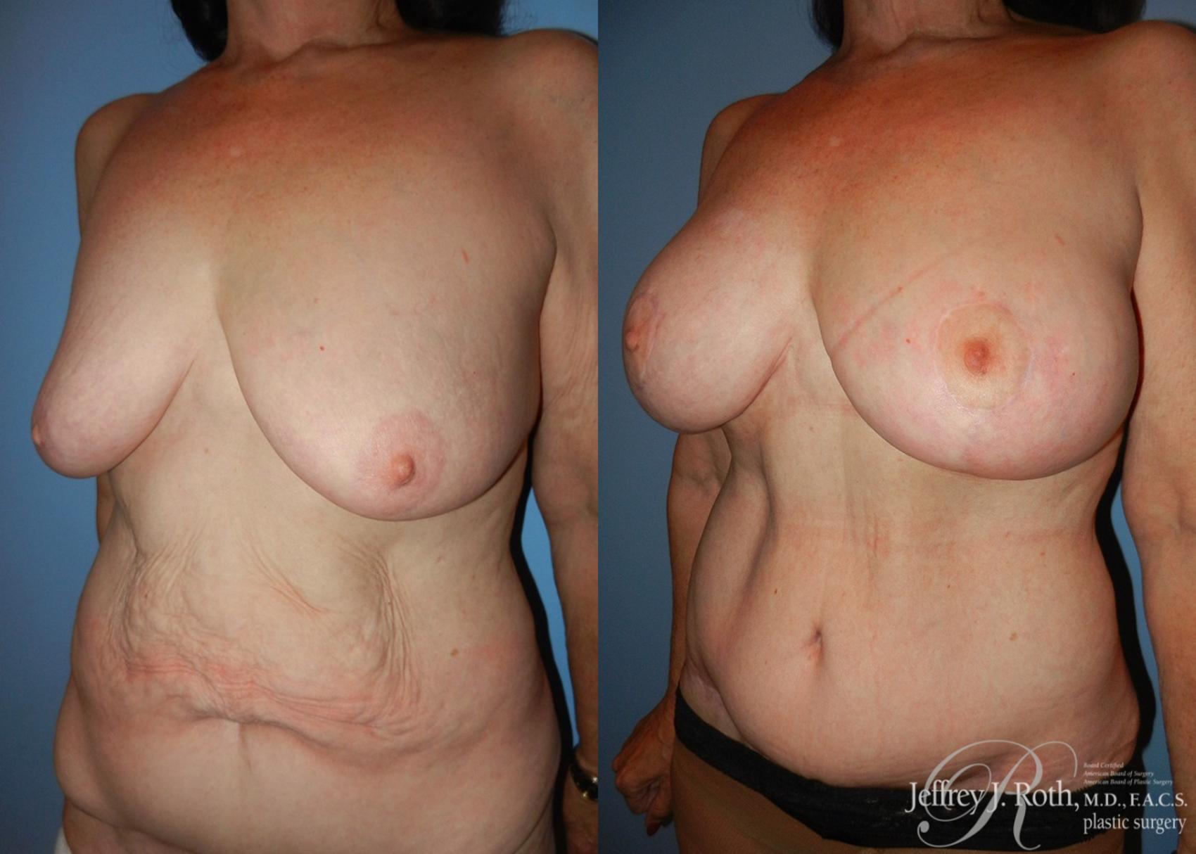 Before & After Breast Lift With Implants Case 64 View #2 View in Las Vegas, NV